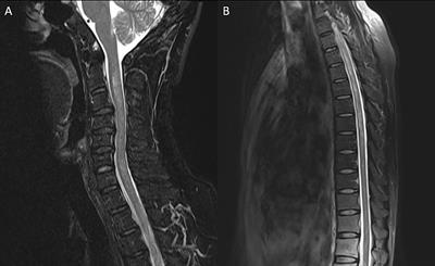 Case Report: Neuromyelitis Optica Spectrum Disorder With Progressive Elevation of Cerebrospinal Fluid Cell Count and Protein Level Mimicking Infectious Meningomyelitis: A Diagnostic Challenge